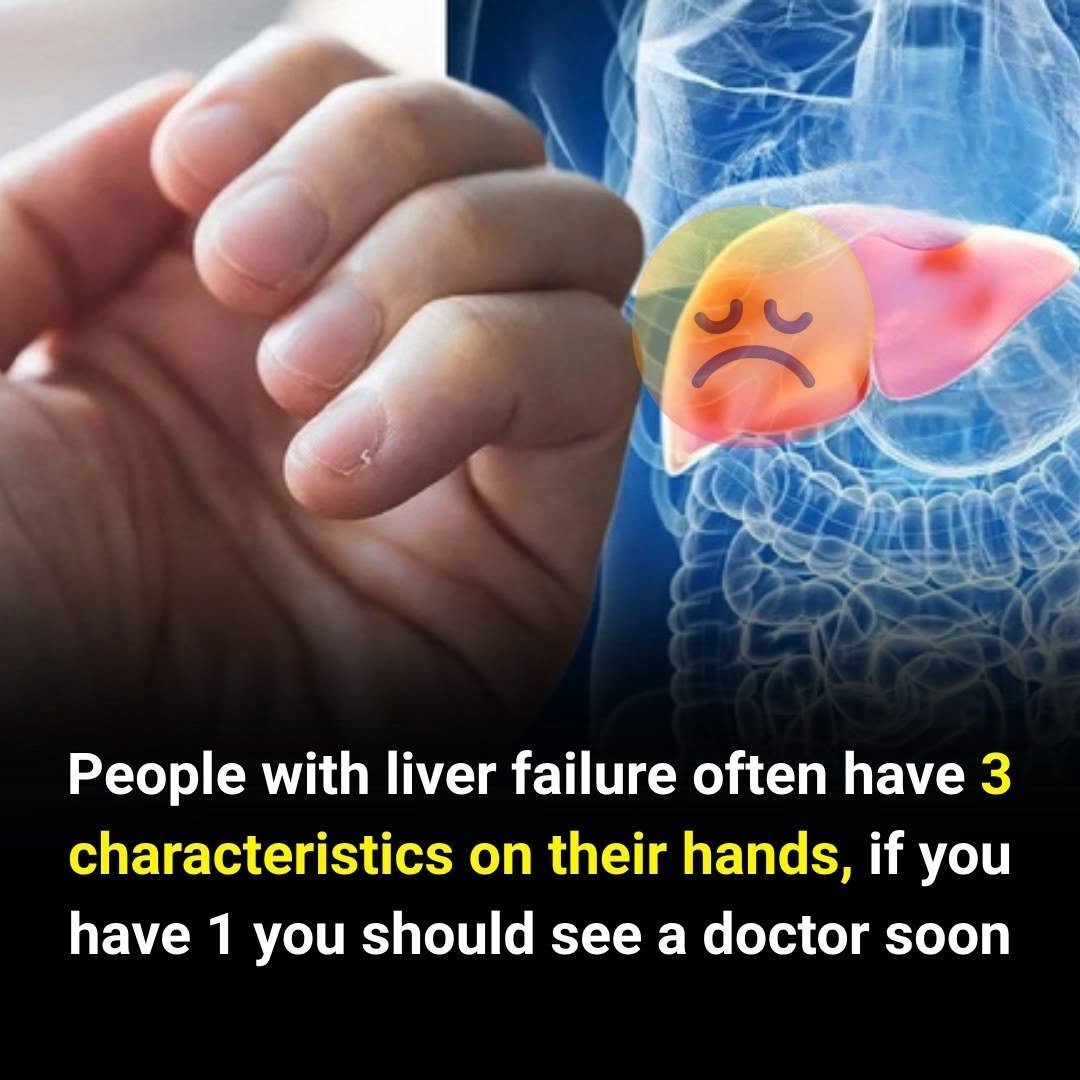 3 Hand Signs That May Signal Liver Problems — Even 1 Deserves Medical Attention