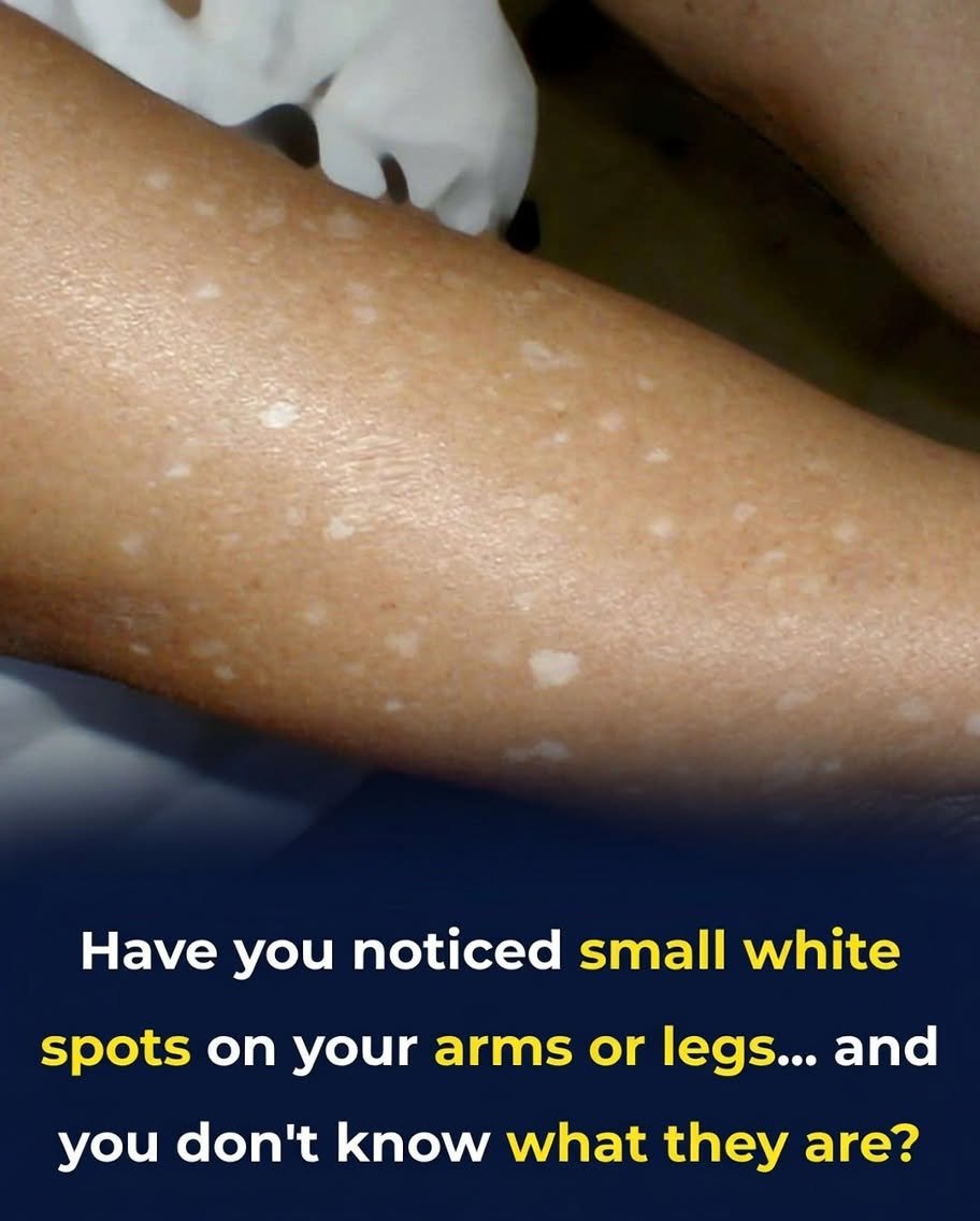 Have You Noticed White Patches on Your Skin? Experts Explain the Possible Causes
