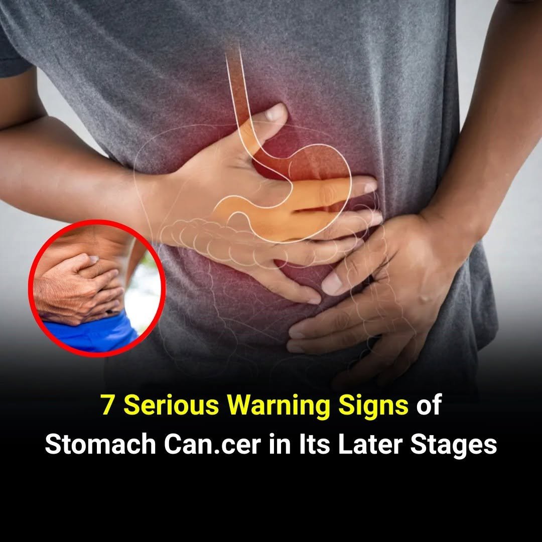 7 Serious Warning Signs of Late-Stage Stomach Cancer You Shouldn’t Ignore