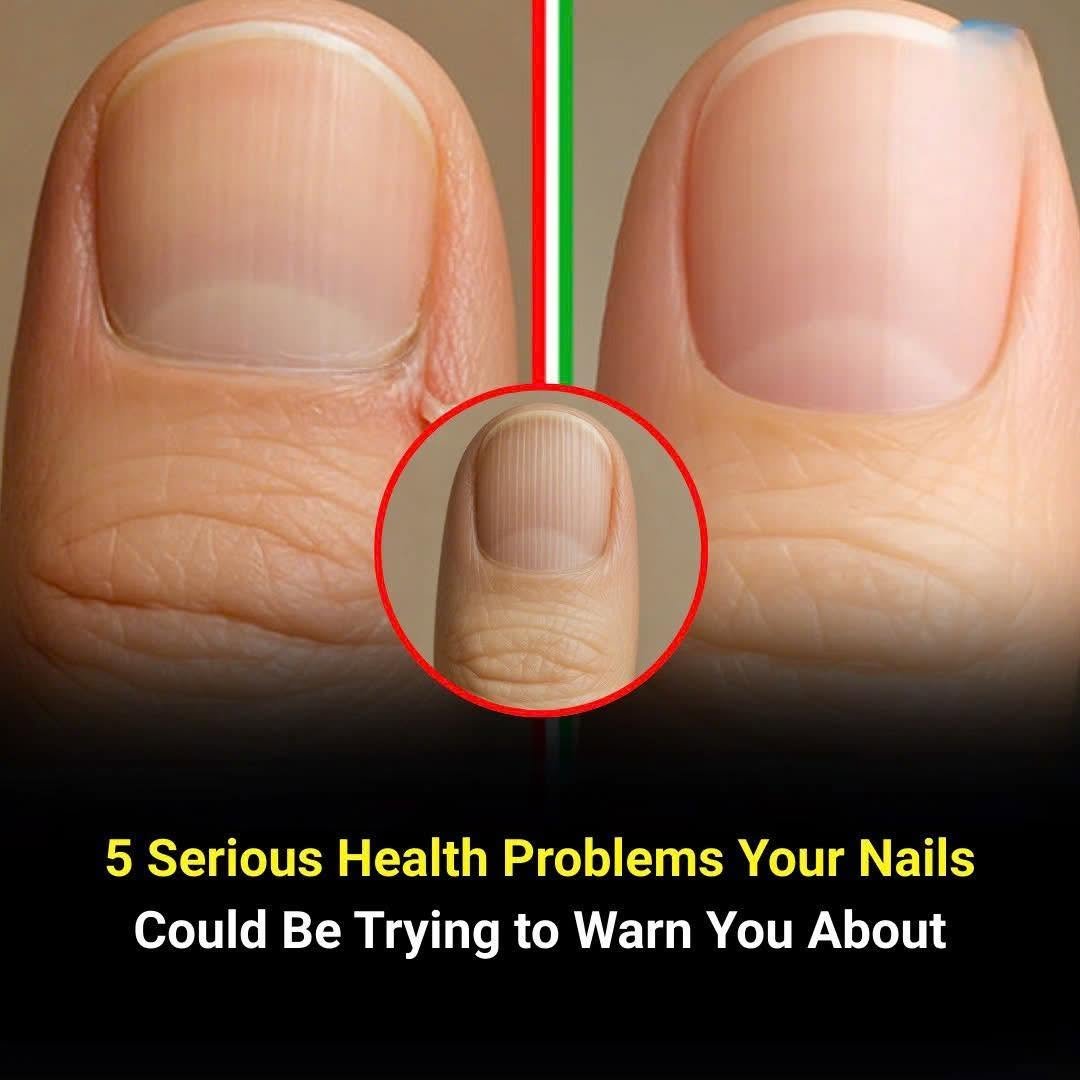 5 Silent Health Problems Your Nails Reveal Before Anything Else — Pay Attention to These Warning Signs!