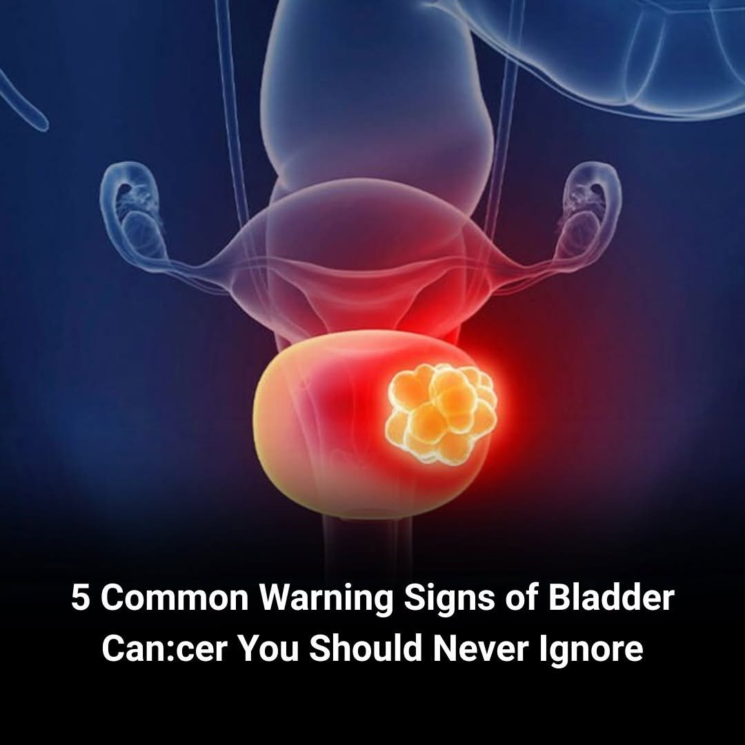 5 Common Bladder Cancer Signs Many People Overlook