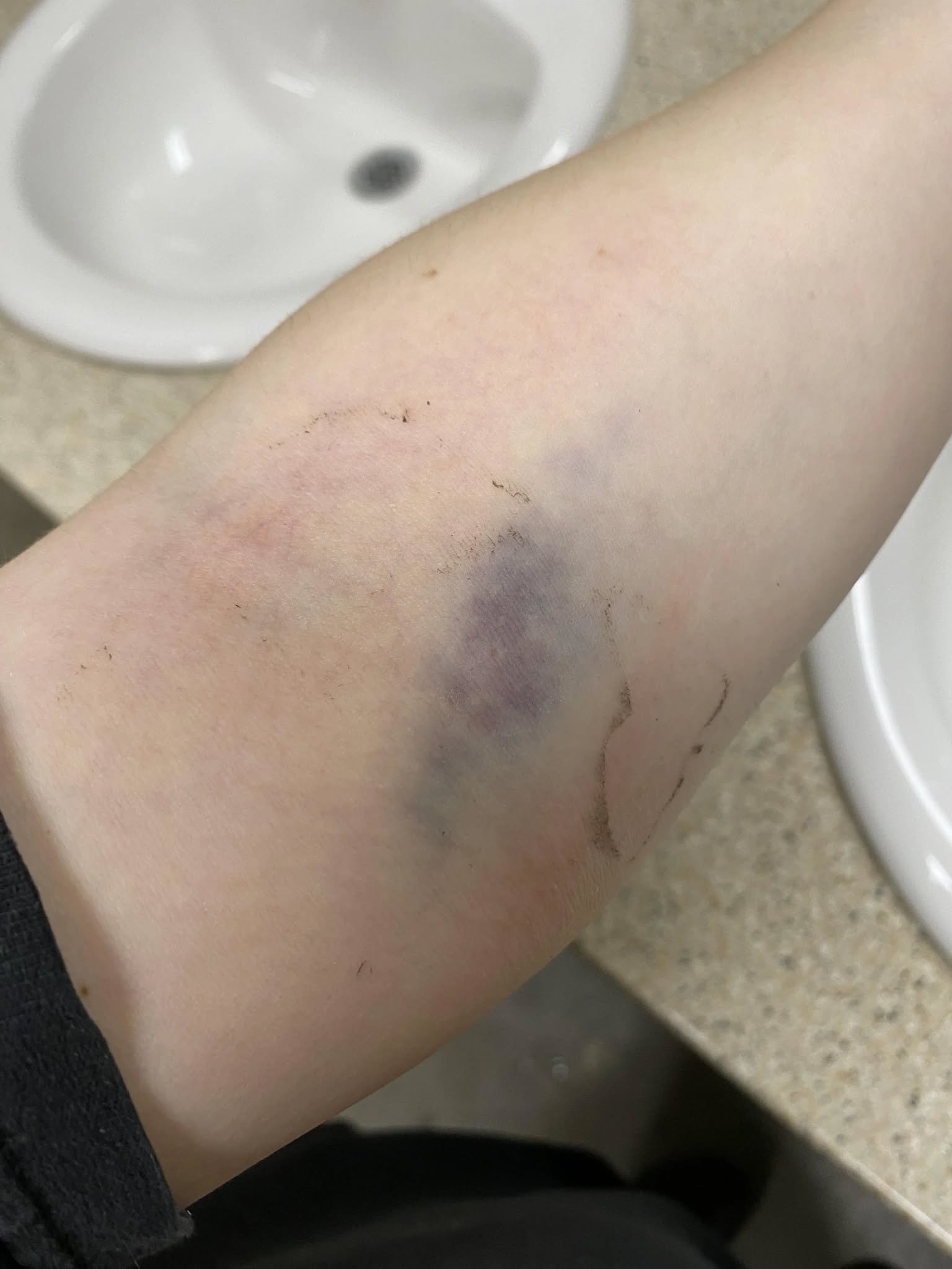Be Careful: If You Get These Bruises, Don’t Ignore the Pattern