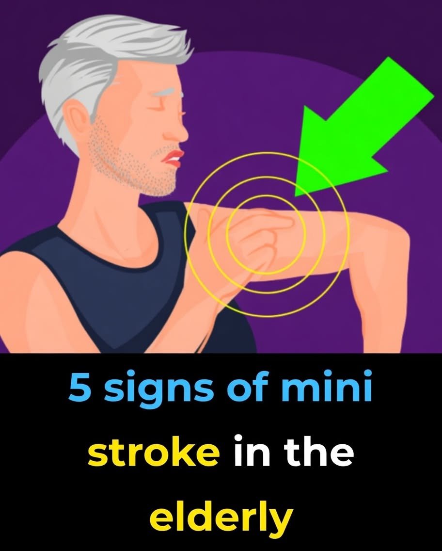 5 Warning Signals of a Mini-Stroke That Could Prevent a Major Stroke