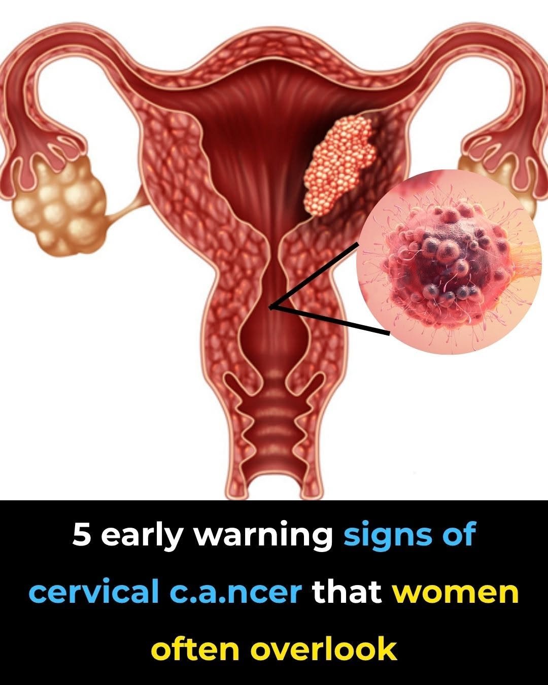 Cervical Cancer Often Develops Silently — 5 Warning Signs You Should Know