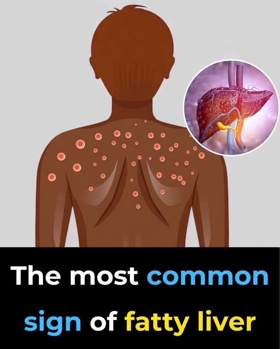 What You Should Know About Fatty Liver Disease, Including Symptoms and Ways to Support Liver Health