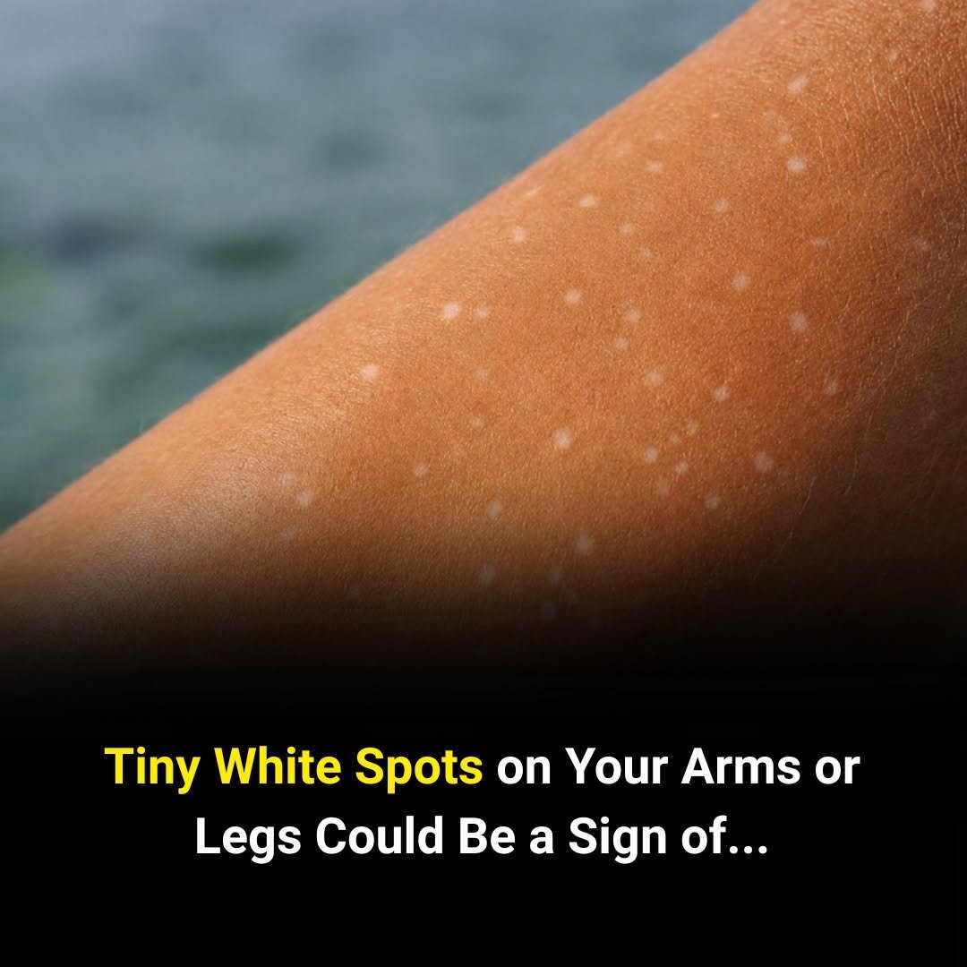 Tiny White Spots on Your Arms or Legs Could Be a Sign of…