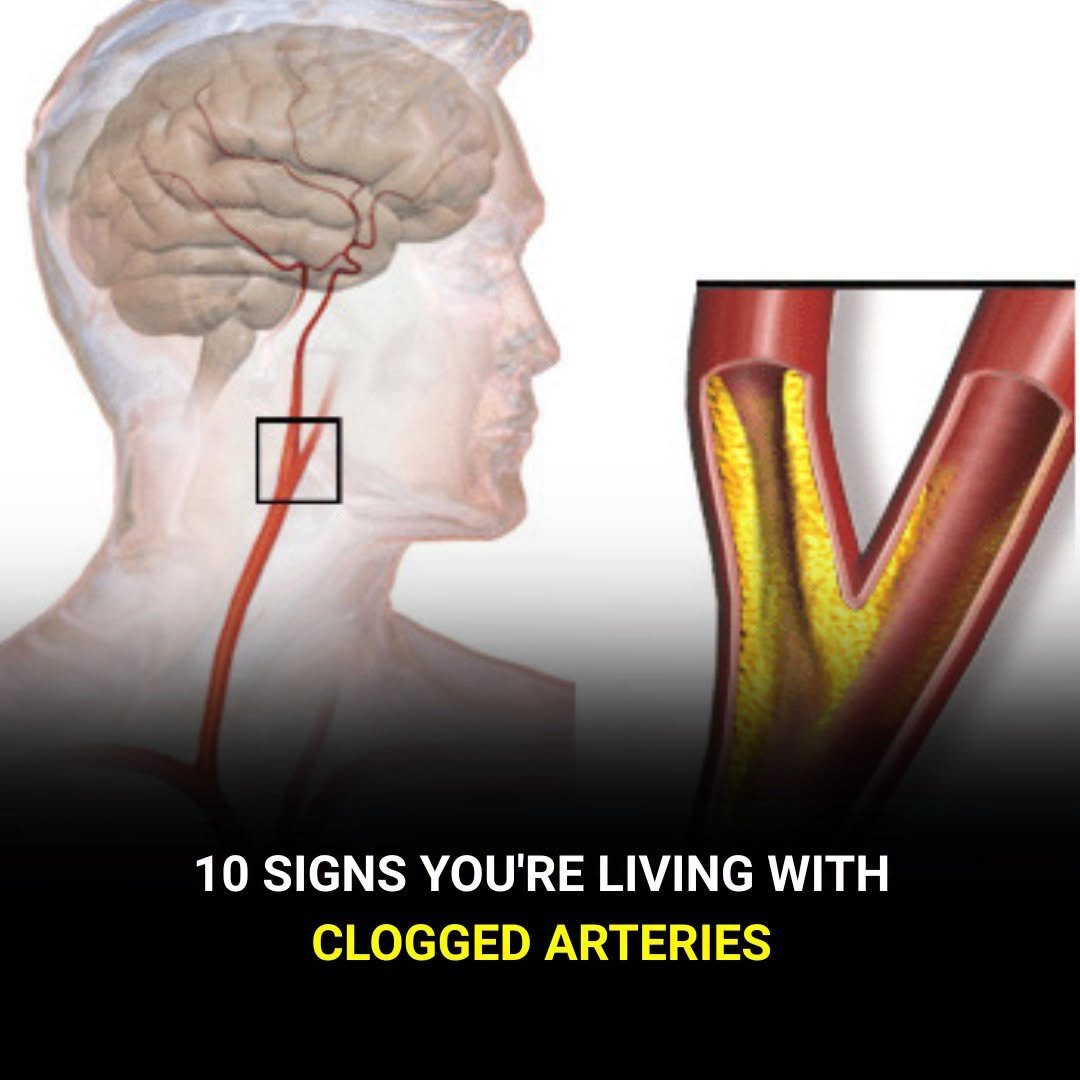10 Warning Signs Your Arteries Might Be Clogged (Don’t Ignore These)