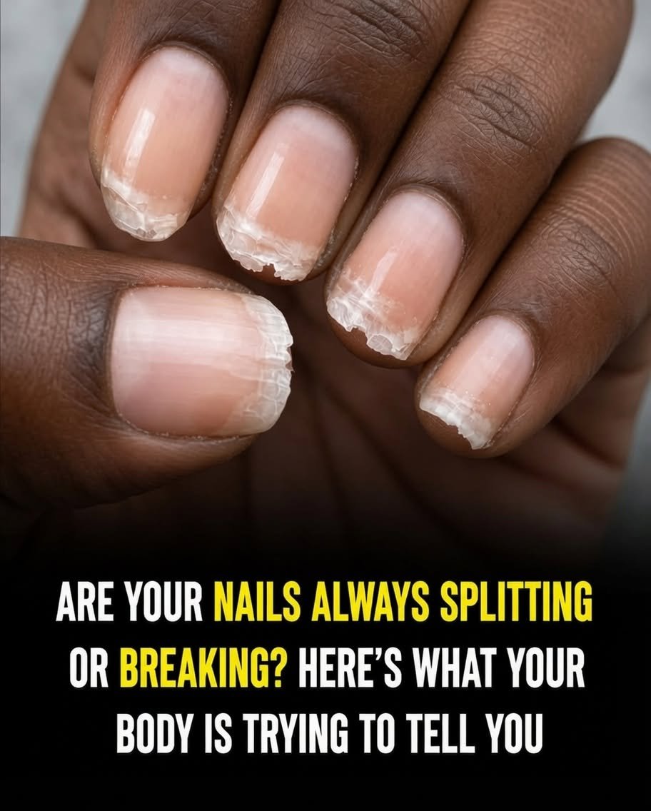Brittle or Weak Nails May Signal More Than a Beauty Concern