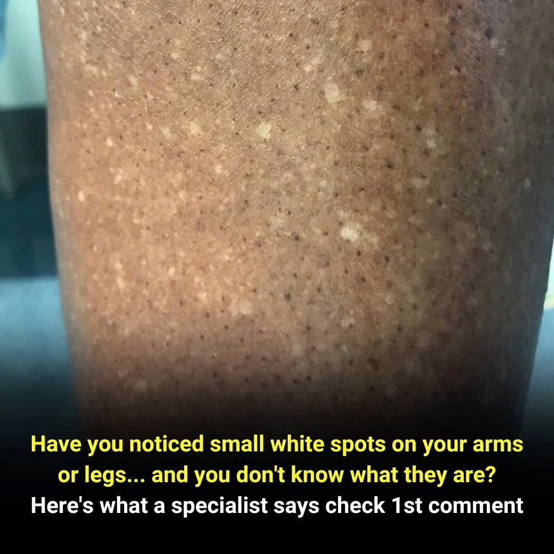 White Spots on Your Arms or Legs? Here’s What Your Body May Be Trying to Tell You
