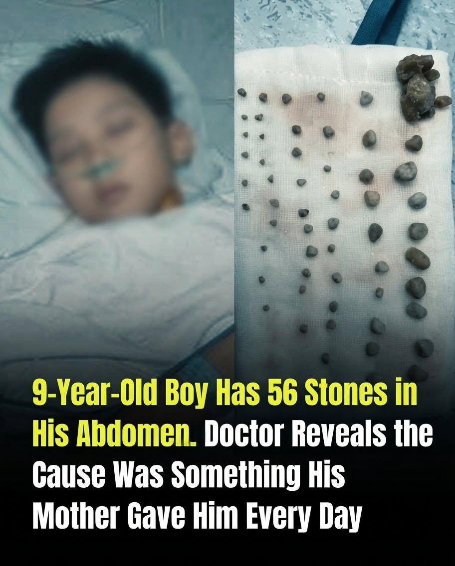 9-Year-Old Boy Found With 56 Stones in His Abdomen — What Doctors Say About the Possible Cause