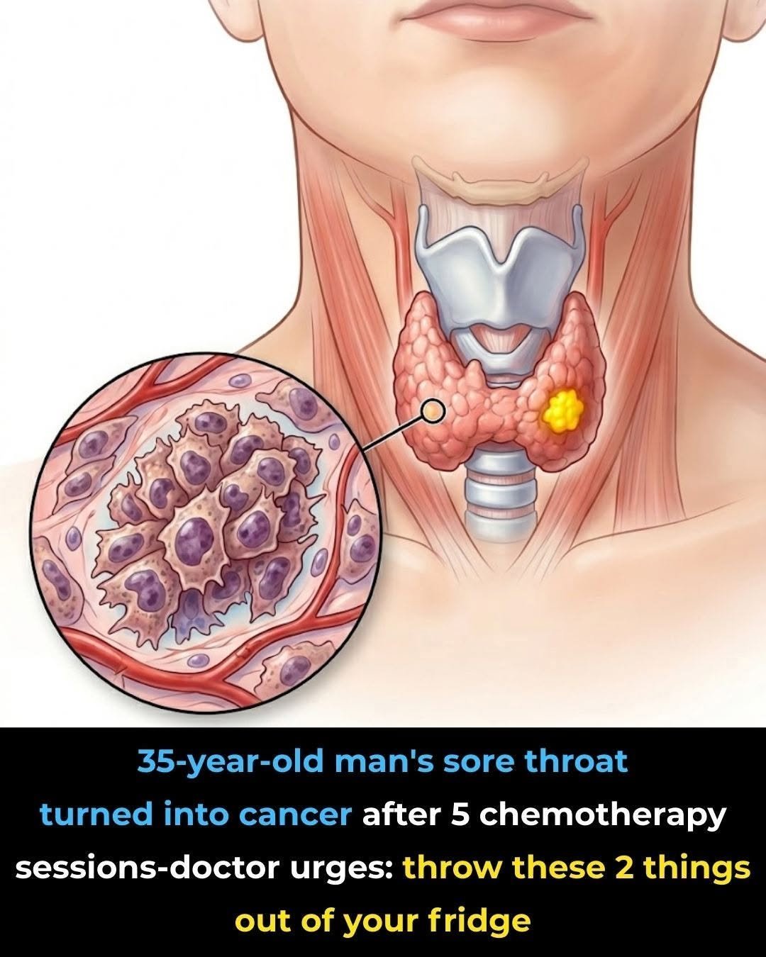 What Started as a Simple Sore Throat Became Cancer After 5 Chemotherapy Sessions — Doctors Say Remove These 2 Items From Your Fridge