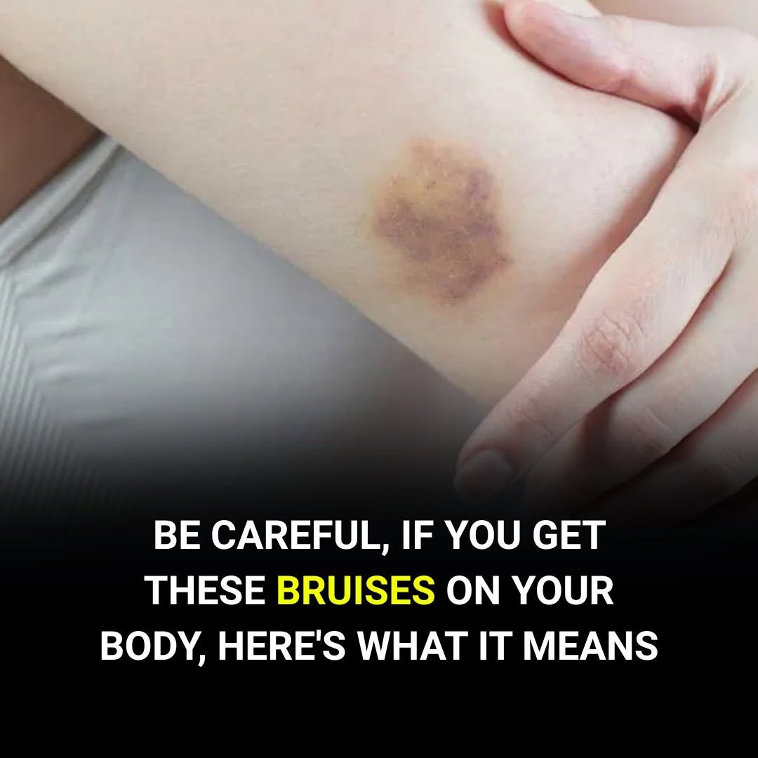 Getting Bruises for No Clear Reason? Here’s What Your Body May Be Trying to Tell You