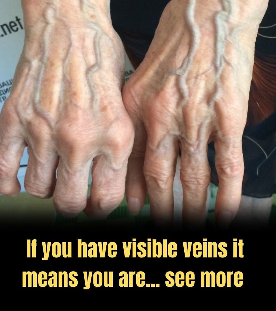 Bulging Veins: When They’re Harmless and When They Could Signal a Problem