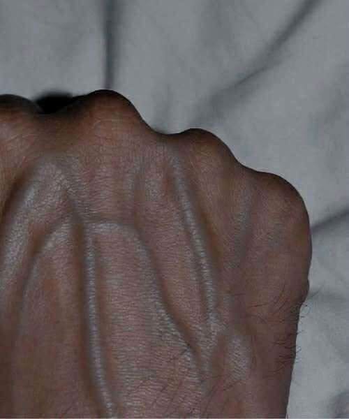Visible veins on the hands can look alarming, particularly when they suddenly become more noticeable, but prominent hand veins are not, by themselves, a reliable sign of cancer. Veins can naturally become easier to see because the skin on the hands is relatively thin, and their visibility may increase with age, lower body fat, genetics, exercise, heat, dehydration, or changes in blood flow. Physical activity can temporarily make veins appear more prominent because blood vessels expand as circulation increases. Warm temperatures can have a similar effect. For many healthy people, visible veins are simply a normal feature of their anatomy and do not indicate an underlying disease. However, a noticeable change that is new, persistent, or accompanied by other symptoms deserves attention rather than being automatically dismissed or attributed to cancer.