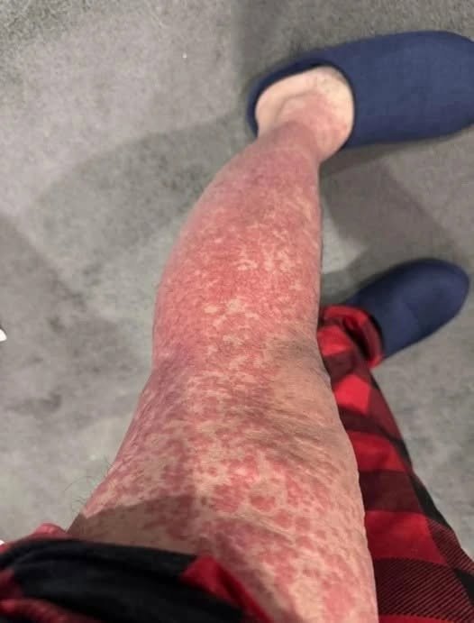 The Hidden Dangers of Bed Heating Pads and Prolonged Thermal Exposure