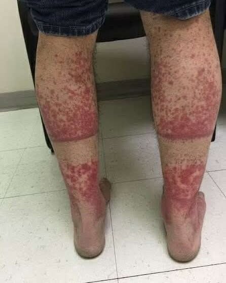 This image depicts a classic example of stasis dermatitis (also known as venous stasis dermatitis or gravitational dermatitis).