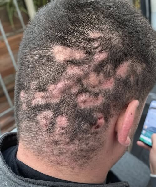 Understanding Patchy Hair Loss and Scalp Inflammation: Causes and Care
