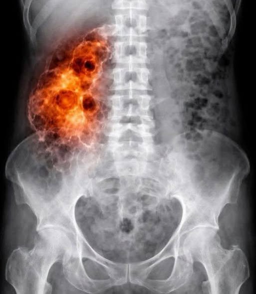 Analyzing Health Misinformation: COVID-19 Vaccines and Kidney Health Claims