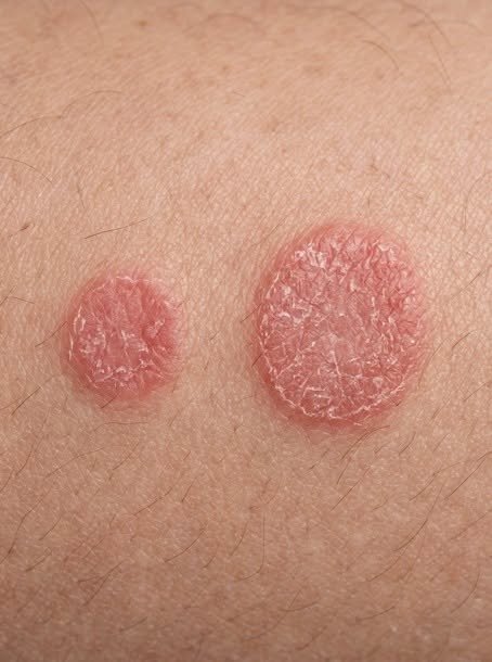 Recognizing Common Skin Lesions: When to Consult a Medical Professional