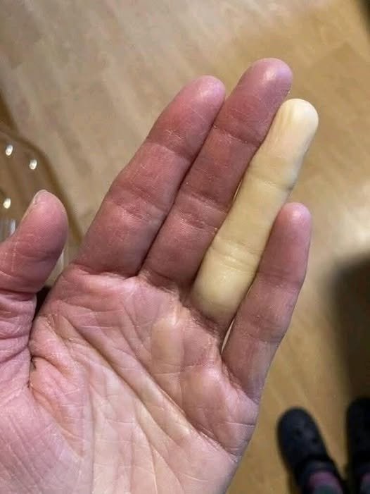 Understanding Vascular Reactivity: Raynaud’s Phenomenon vs. Sensational Headlines