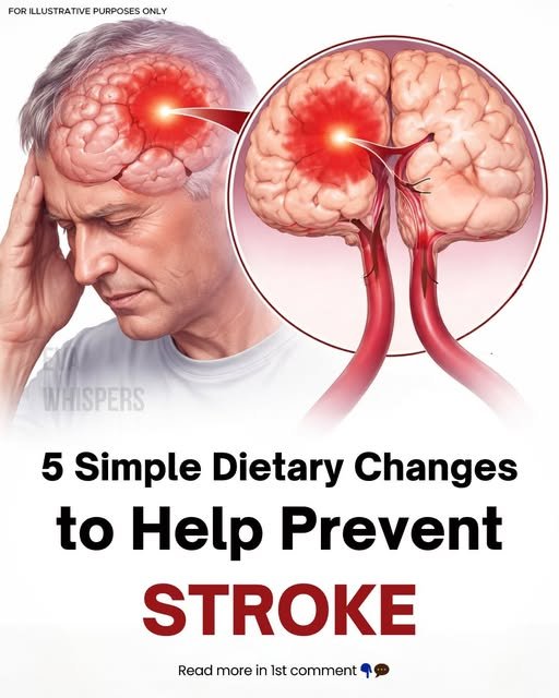 Medical Reality: Evidence-Based Dietary Prevention of Stroke