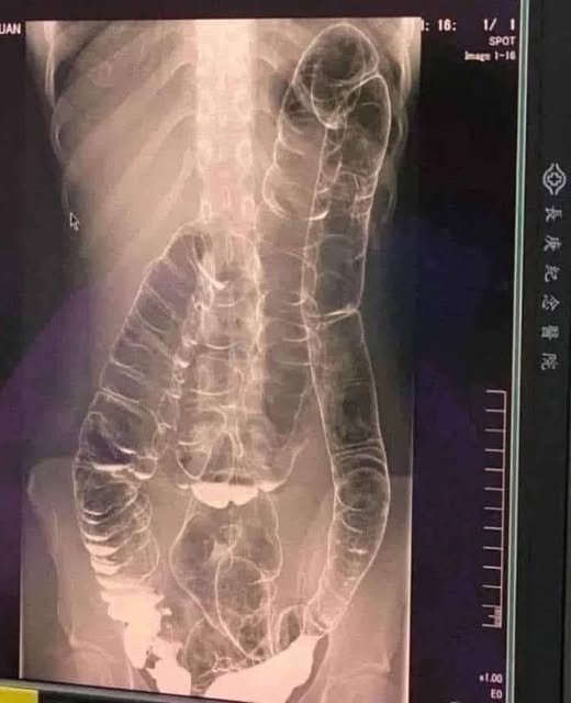 Radiologic Reality: Deconstructing the “Severe Constipation” X-Ray