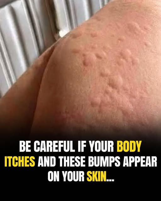Medical Reality: Understanding Hives (Urticaria)